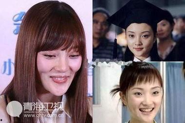 整容后遗症明星,美丽代价与反思